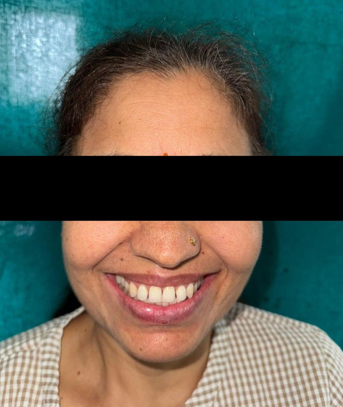 Laminates Veneers Gallery 1